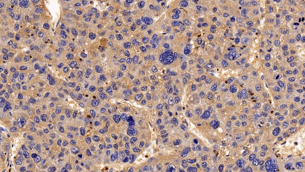 Immunohistochemistry-Paraffin: RGS19 Antibody [NBP3-41987] - DAB staining on IHC-P; Sample: Human Liver cancer Tissue; Primary Ab: 10ug/ml NBP3-41987; Second Ab: 2ug/mL HRP-Linked Caprine Anti-Rabbit IgG Polyclonal Antibody