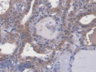 Immunohistochemistry-Paraffin: ECRG4 Antibody [NBP3-42009] - DAB staining on IHC-P; Samples: Human Thyroid cancer Tissue
