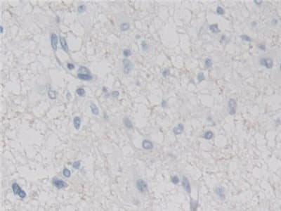 Immunohistochemistry-Paraffin: MX2 Antibody [NBP3-42029] - DAB staining on IHC-P; Samples: Human Glioma Tissue; Primary Ab: 30ug/ml NBP3-42029; Second Ab: 2ug/mL HRP-Linked Caprine Anti-Rabbit IgG Polyclonal Antibody