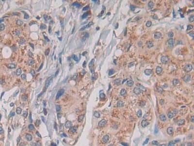 Immunohistochemistry-Paraffin: TLR1 Antibody (8-3#) [NBP3-42220] - DAB staining on IHC-P; Samples: Human Breast cancer Tissue; Primary Ab: 20ug/ml NBP3-42220; Second Ab: 2ug/mL HRP-Linked Caprine Anti-Mouse IgG Polyclonal Antibody