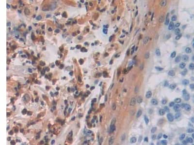 Immunohistochemistry-Paraffin: EMP/MAEA Antibody [NBP3-42340] - DAB staining on IHC-P; Samples: Human Skin cancer Tissue; Primary Ab: 10ug/ml NBP3-42340; Second Ab: 2ug/mL HRP-Linked Caprine Anti-Rabbit IgG Polyclonal Antibody