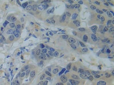 Immunohistochemistry-Paraffin: SNRPC Antibody [NBP3-42342] - DAB staining on IHC-P; Samples: Human Breast cancer Tissue; Primary Ab: 10ug/ml NBP3-42342
