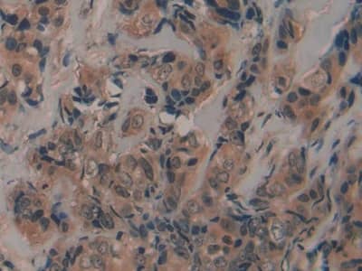 Immunohistochemistry-Paraffin: Fibrillin 2 Antibody [NBP3-42353] - DAB staining on IHC-P; Samples: Human Breast cancer Tissue; Primary Ab: 20ug/ml NBP3-42353