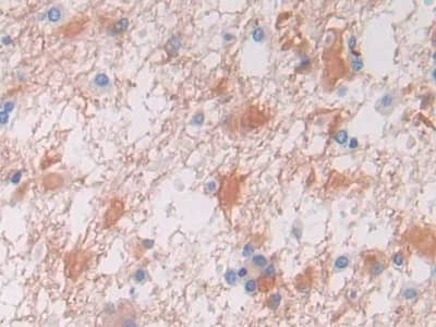 Immunohistochemistry-Paraffin: VWA3A Antibody [NBP3-42362] - DAB staining on IHC-P; Samples: Human Glioma Tissue; Primary Ab: 30ug/ml NBP3-42362; Second Ab: 2ug/mL HRP-Linked Caprine Anti-Rabbit IgG Polyclonal Antibody