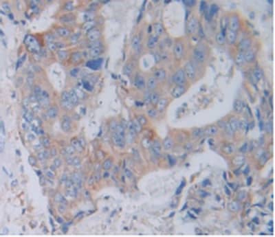 Immunohistochemistry-Paraffin: Cathepsin V Antibody [NBP3-42366] - DAB staining on IHC-P; Samples: Human Rectum Cancer Tissue