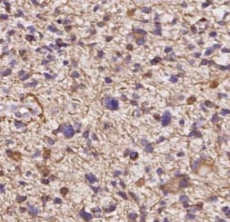 Immunohistochemistry: BCS1L Antibody (9G10) [NBP3-42922] - Immunohistochemistry of paraffin-embedded human gliomas using (BCS1L antibody) at dilution of 1:50