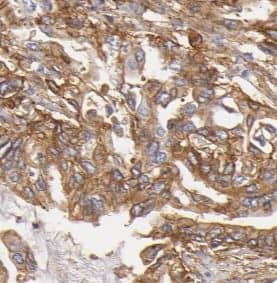 Immunohistochemistry: Pancreatic Amylase Alpha Antibody (1C7) [NBP3-42927] - Immunohistochemistry of paraffin-embedded human pancreas cancer tissue slide using (Pancreatic Amylase Alpha Antibody) at dilution of 1:50