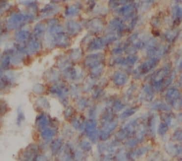 Immunohistochemistry: ATPG Antibody (8H11) [NBP3-42931] - Immunohistochemistry of paraffin-embedded human liver cancer tissue slide using (ATPG Antibody) at dilution of 1:200 heat mediated antigen retrieved with Tris-EDTA buffer(pH9)