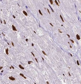 Immunohistochemistry: BRD8 Antibody (4B2) [NBP3-42936] - Immunohistochemistry of paraffin-embedded human colon cancer tissue slide using (BRD8 Antibody) at dilution of 1:200