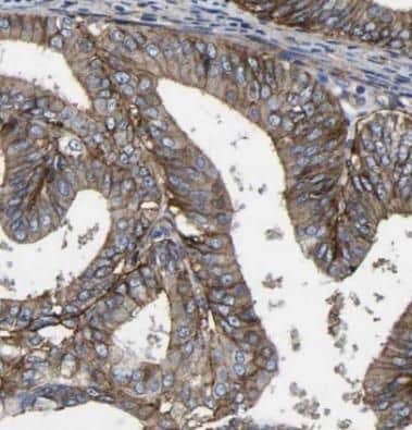 Immunohistochemistry: Ceruloplasmin Antibody (8F3) [NBP3-42940] - Immunohistochemistry of paraffin-embedded human ovary tumor tissue slide using (Ceruloplasmin Antibody) at dilution of 1:200 heat mediated antigen retrieved with Tris-EDTA buffer(pH9).