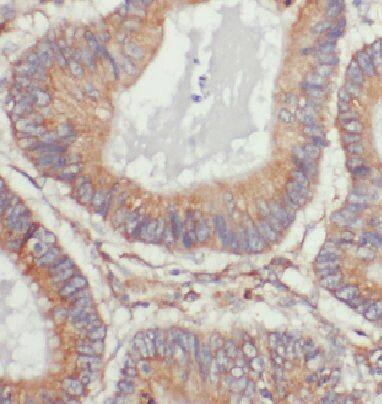 Immunohistochemistry: DDB1 Antibody (3A0) [NBP3-42957] - Immunohistochemistry of paraffin-embedded human cervical cancer using (DDB1 antibody) at dilution of 1:200