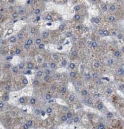 Immunohistochemistry: SART2 Antibody (3G11) [NBP3-42959] - Immunohistochemistry of paraffin-embedded human liver cancer tissue slide using (SART2 Antibody) at dilution of 1:200