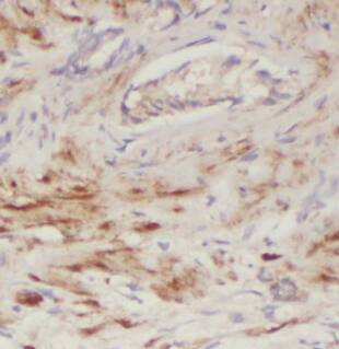 Immunohistochemistry: ECHS1 Antibody (1H0) [NBP3-42960] - Immunohistochemistry of paraffin-embedded human prostate cancer tissue slide using (ECHS1 Antibody) at dilution of 1:50