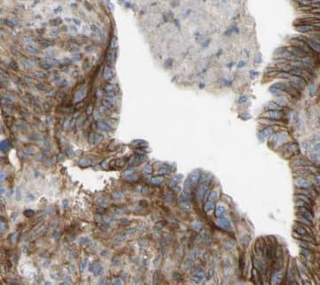 Immunohistochemistry: EEF1D Antibody (6D9) [NBP3-42962] - Immunohistochemistry of paraffin-embedded human pancreas cancer tissue slide using (EEF1D Antibody) at dilution of 1:200