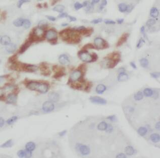 Immunohistochemistry: EEF1D Antibody (0H1) [NBP3-42963] - Immunohistochemistry of paraffin-embedded human pancreas cancer slide using (EEF1D Antibody) at dilution of 1:50