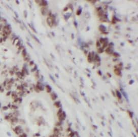 Immunohistochemistry: RRP4 Antibody (6E9) [NBP3-42968] - Immunohistochemistry of paraffin-embedded human skin cancer slide using (RRP4 Antibody) at dilution of 1:50