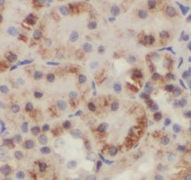 Immunohistochemistry: GDI2 Antibody (0B10) [NBP3-42973] - Immunohistochemistry of paraffin-embedded human breast cancer tissue slide using (GDI2 Antibody) at dilution of 1:50