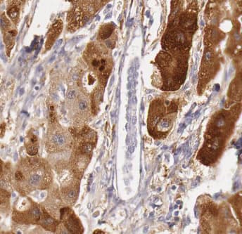 Immunohistochemistry: Aspartate Aminotransferase Antibody (2F1) [NBP3-42977] - Immunohistochemistry of paraffin-embedded human liver cancer tissue slide using (Aspartate Aminotransferase Antibody) at dilution of 1:200