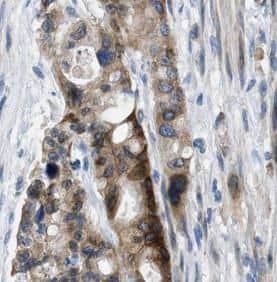 Immunohistochemistry: alcohol dehydrogenase 5 Antibody (3E7) [NBP3-42978] - Immunohistochemistry of paraffin-embedded human pancreas cancer tissue slide using (alcohol dehydrogenase 5 Antibody) at dilution of 1:50