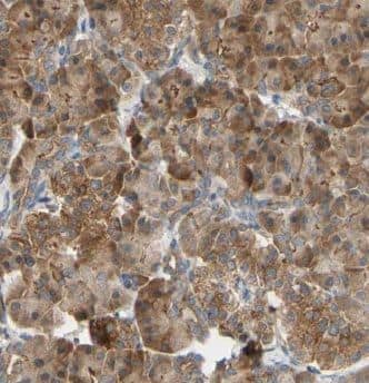 Immunohistochemistry: GSTO1 Antibody (9H4) [NBP3-42979] - Immunohistochemistry of paraffin-embedded human oesophagus cancer tissue slide using (GSTO1 Antibody) at dilution of 1:200 heat mediated antigen retrieved with Tris-EDTA buffer(pH9).