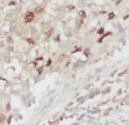 Immunohistochemistry: LONP1 Antibody (9H10) [NBP3-42990] - Immunohistochemistry of paraffin-embedded human lung cancer tissue slide using (LONP1 Antibody) at dilution of 1:800 heat mediated antigen retrieved with Tris-EDTA buffer(pH9).