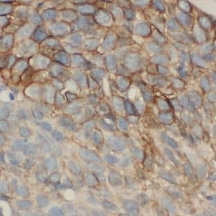 Immunohistochemistry: MAGEA3 Antibody (4E9) [NBP3-42992] - Immunohistochemistry of paraffin-embedded human lung cancer tissue slide using (MAGEA3 Antibody) at dilution of 1:200 heat mediated antigen retrieved with Tris-EDTA buffer(pH9).