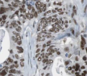 Immunohistochemistry: O-GlcNAcase/OGA/MGEA5 Antibody (9B9) [NBP3-42998] - Immunohistochemistry of paraffin-embedded human gliomas using (O-GlcNAcase/OGA/MGEA5 antibody) at dilution of 1:50