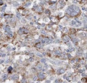 Immunohistochemistry: MMS19 like protein Antibody (6H1) [NBP3-43000] - Immunohistochemistry of paraffin-embedded human cervical cancer using (MMS19 like protein antibody) at dilution of 1:50