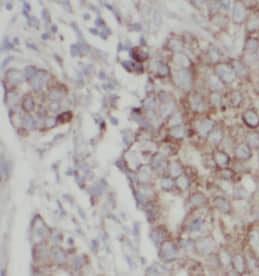 Immunohistochemistry: NDUFA4L2 Antibody (0B11) [NBP3-43005] - Immunohistochemistry of paraffin-embedded human breast cancer tissue slide using (NDUFA4L2 Antibody) at dilution of 1:500