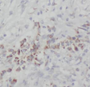 Immunohistochemistry: NOB1 Antibody (8G0) [NBP3-43007] - Immunohistochemistry of paraffin-embedded human breast cancer tissue slide using (NOB1 Antibody) at dilution of 1:200