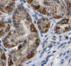 Immunohistochemistry: NUMBL Antibody (8E0) [NBP3-43009] - Immunohistochemistry of paraffin-embedded human gliomas tissue slide using (NUMBL Antibody) at dilution of 1:50