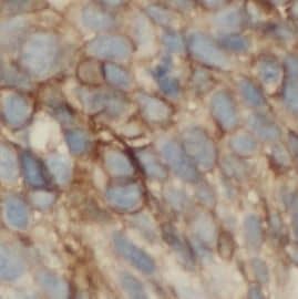 Immunohistochemistry: Orai1 Antibody (8C0) [NBP3-43010] - Immunohistochemistry of paraffin-embedded human lung cancer tissue slide using (Orai1 Antibody) at dilution of 1:200