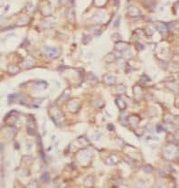 Immunohistochemistry: P4HA1 Antibody (4F1) [NBP3-43012] - Immunohistochemistry of paraffin-embedded human breast cancer tissue slide using (P4HA1 Antibody) at dilution of 1:500 heat mediated antigen retrieved with Tris-EDTA buffer(pH9).