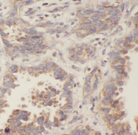 Immunohistochemistry: Profilin 2 Antibody (5D4) [NBP3-43015] - Immunohistochemistry of paraffin-embedded human lung cancer tissue slide using (Profilin 2 Antibody) at dilution of 1:400