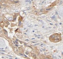 Immunohistochemistry: PLOD3 Antibody (2B1) [NBP3-43020] - Immunohistochemistry of paraffin-embedded human pancreas cancer using (PLOD3 antibody) at dilution of 1:100