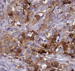 Immunohistochemistry: RABEP2 Antibody (2F7) [NBP3-43022] - Immunohistochemistry of paraffin-embedded human prostate cancer tissue slide using (RABEP2 Antibody) at dilution of 1:50