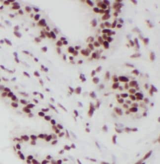 Immunohistochemistry: RBM15 Antibody (6B1) [NBP3-43026] - Immunohistochemistry of paraffin-embedded human breast cancer tissue slide using (RBM15 antibody) at dilution of 1:500