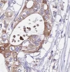 Immunohistochemistry: RISC Antibody (1C4) [NBP3-43028] - Immunohistochemistry of paraffin-embedded human pancreas cancer tissue slide using (RISC antibody at dilution of 1:200