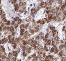 Immunohistochemistry: RPL3 Antibody (3F3) [NBP3-43030] - Immunohistochemistry of paraffin-embedded human liver cancer tissue slide using (RPL3 Antibody) at dilution of 1:600 heat mediated antigen retrieved with Tris-EDTA buffer(pH9).