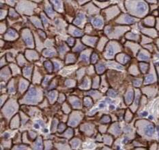 Immunohistochemistry: SGTA Antibody (9E10) [NBP3-43034] - Immunohistochemistry of paraffin-embedded human liver cancer tissue slide using (SGTA Antibody) at dilution of 1:200