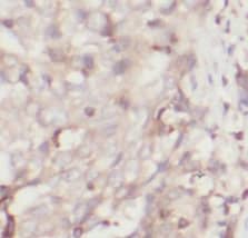 Immunohistochemistry: BAF57 Antibody (1G10) [NBP3-43036] - Immunohistochemistry of paraffin-embedded human breast cancer tissue slide using (BAF57 Antibody) at dilution of 1:100