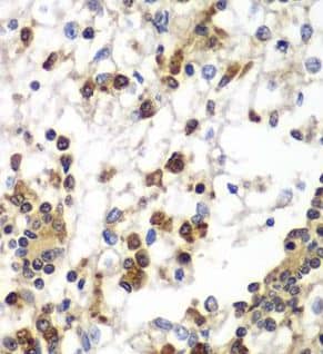 Immunohistochemistry: SND1 Antibody (0A1) [NBP3-43037] - Immunohistochemistry of paraffin-embedded human kidney cancer using (SND1 Antibody) at dilution of 1:100