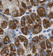 Immunohistochemistry: SLP-2 Antibody (5D10) [NBP3-43042] - Immunohistochemistry of paraffin-embedded human stomach cancer tissue slide using (SLP-2 Antibody) at dilution of 1:400 heat mediated antigen retrieved with Tris-EDTA buffer(pH9).