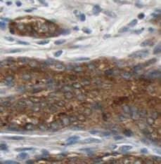 Immunohistochemistry: TFIP11 Antibody (3H5) [NBP3-43044] - Immunohistochemistry of paraffin-embedded human prostate cancer tissue slide using (TFIP11 Antibody) at dilution of 1:50