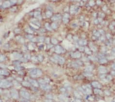 Immunohistochemistry: transgelin 2 Antibody (7D0) [NBP3-43050] - Immunohistochemistry of paraffin-embedded human colon cancer tissue slide using (transgelin 2 Antibody) at dilution of 1:50