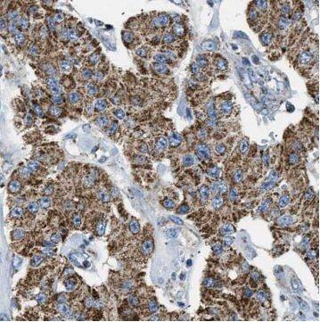 Immunohistochemistry: TRIP6 Antibody (2G2) [NBP3-43054] - Immunohistochemistry of paraffin-embedded human colon cancer using (TRIP6 antibody) at dilution of 1:50