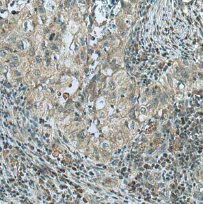 Immunohistochemistry: Glucose 6 phosphate isomerase Antibody (4F11) [NBP3-43065] - Immunohistochemistry of paraffin-embedded human lung cancer tissue slide using (Glucose 6 phosphate isomerase antibody) at dilution of 1:500