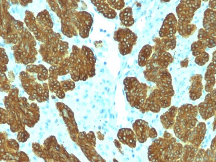 Formalin-fixed, paraffin-embedded human Basal Cell Carcinoma stained with Cytokeratin 5/6 Antibody (KRT5.6/2090).