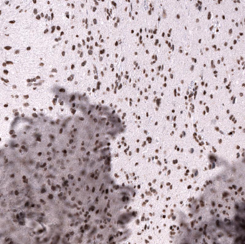 Staining of human astrocytoma shows strong nuclear positivity in tumor cells.