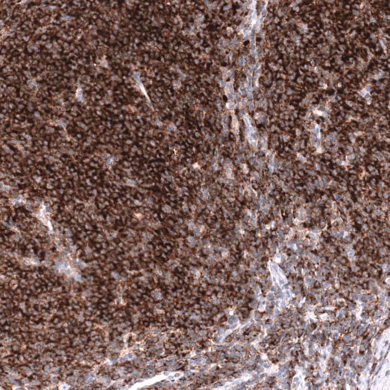 Staining of human mantle cell lymphoma shows strong positivity in tumor cells.